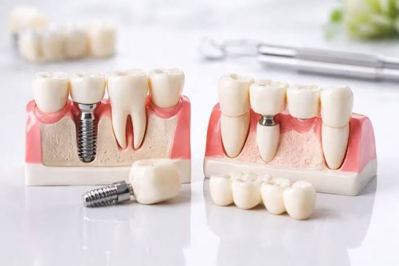 Dental implant vs dental bridge comparison guide