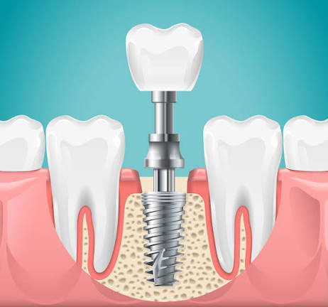 Dental implants guide for Kenyans