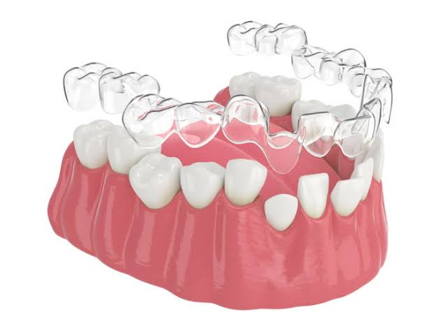 Invisalign clear aligners review Kenya