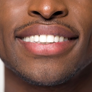 Porcelain dental veneers guide Kenya